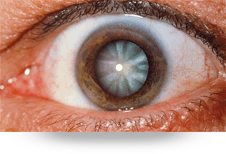 oftalmología-catarata