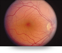 enfermedades de la retina