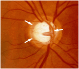 oftalmología-glaucoma