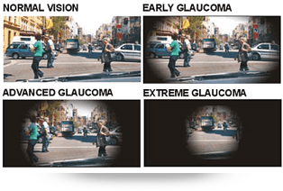 oftalmologia-glaucomatipos