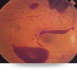 retinopatia_diabetica