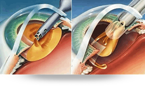 insercion-del-lente-intraocular